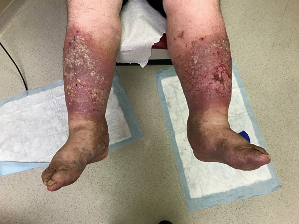 4. Venous ulcers in edematous legs, stasis dermatitis