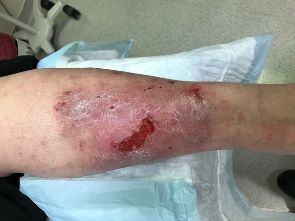 5. Venous ulcer: indurated margins, red granulation tissue 