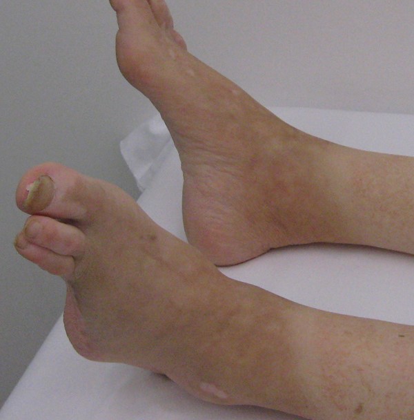 icd-10-code-2019-for-left-foot-cellulitis