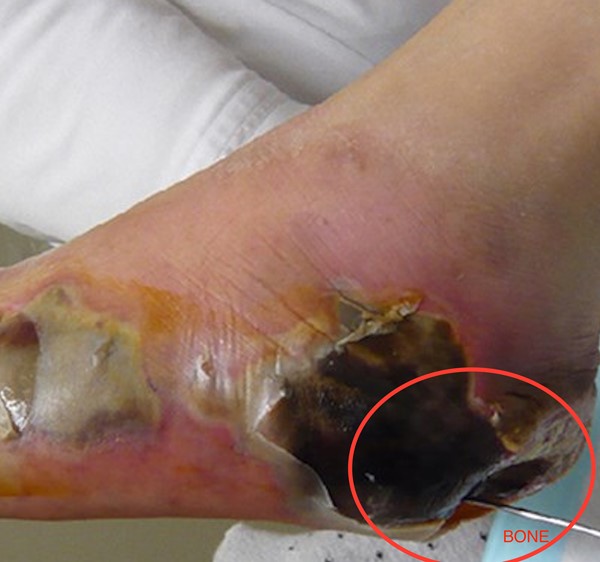 icd 10 diabetic foot ulcer with osteomyelitis reakcióvázlat kezelésére a 2. típusú diabetes