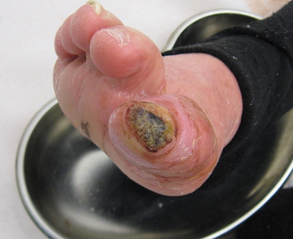 left great toe diabetic ulcer icd 10)