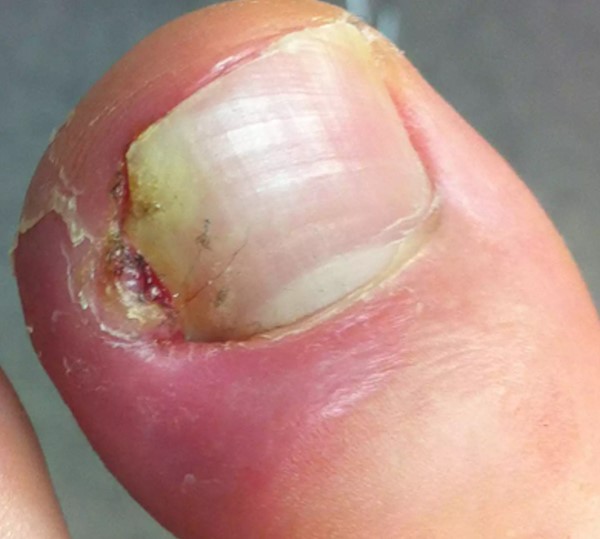 ICD-10 Codes to Report Diabetic Blisters
