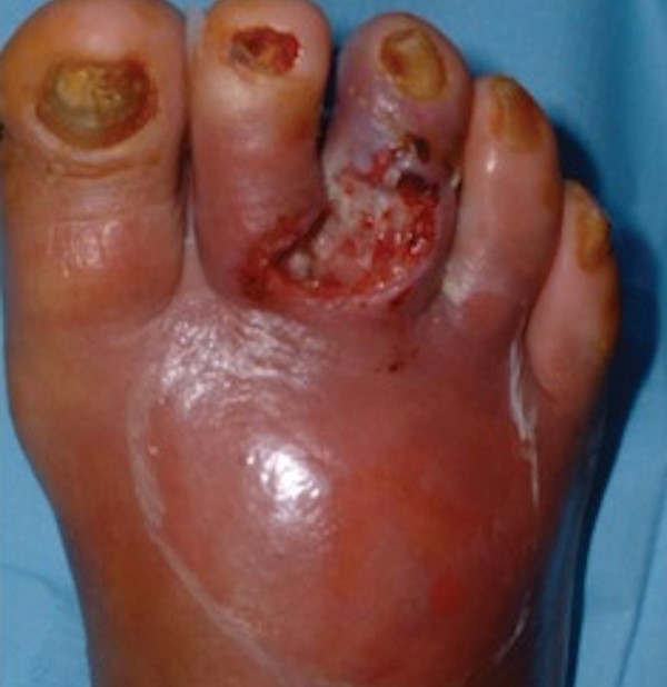 Diabetic Foot Ulcers - Classification Systems