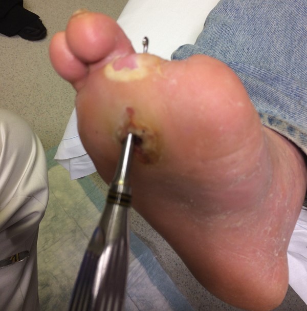 icd 10 code for diabetic foot infection with osteomyelitis