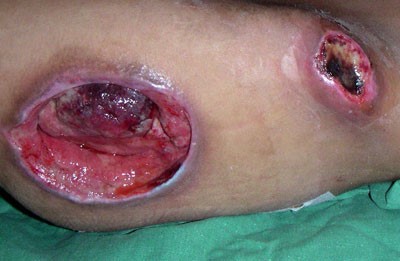 Pressure ulcer/injury By Dr. Andreas Settje, via Wikimedia Commons