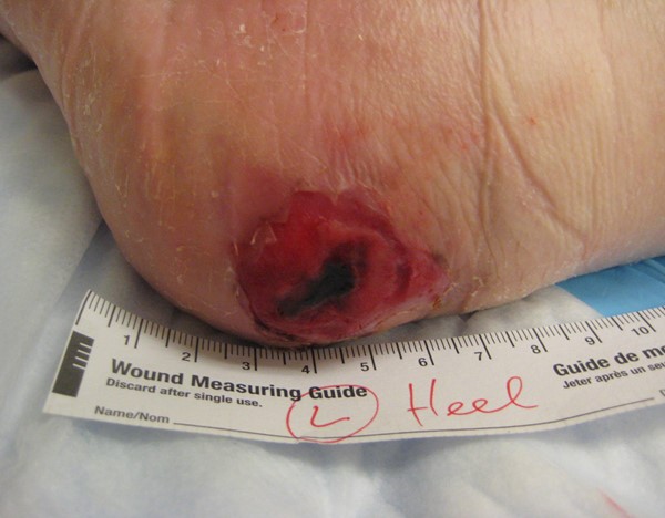 Pressure ulcer on heel. By Nataliya Lebendiskaya, RN, BSN, CWOCN