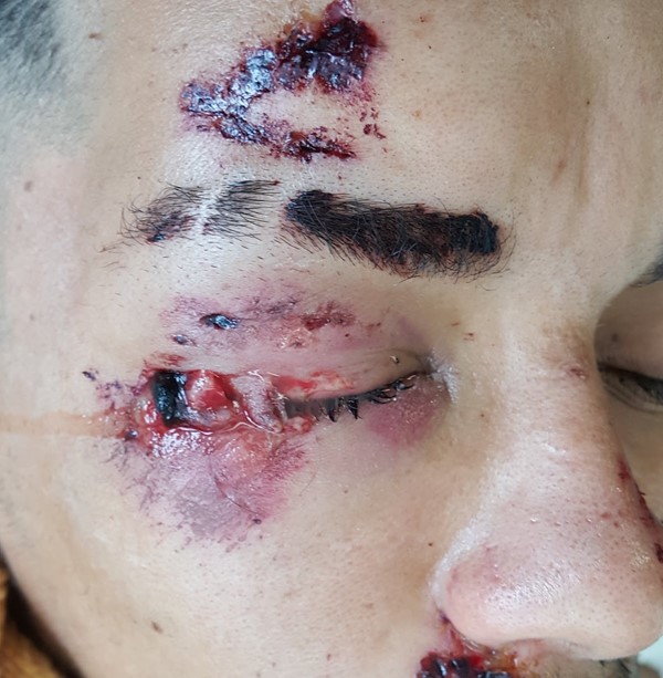 Fig. 1. Traumatic wound (example of acute wound)