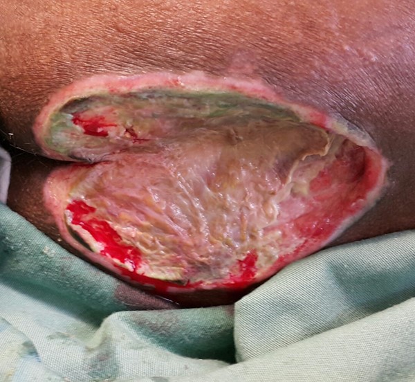 Sacral pressure ulcer/injury (example of chronic wound).