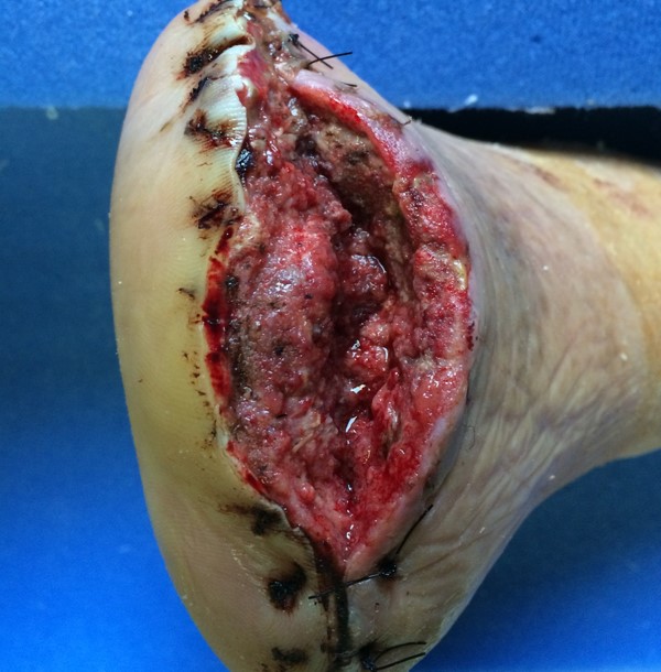 Full-thickness wound (surgical dehiscence)