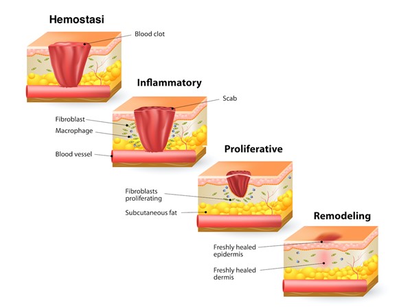 Phases of wound healing