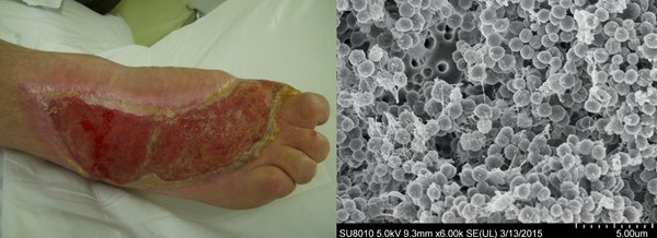 Chronic wound and biofilm