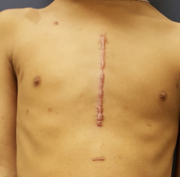 Hypertrophic scar