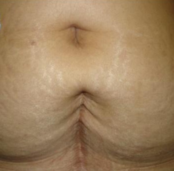 Atrophic and enlarged dermal scar post abdominal surgery 