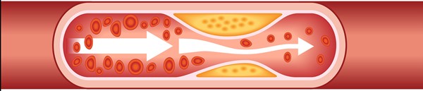 Artery with stenosis