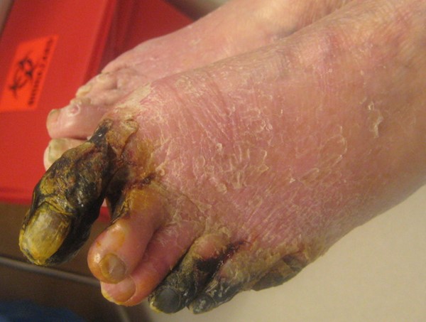 Dry gangrene of the toes. By Lebedinskaya N. 