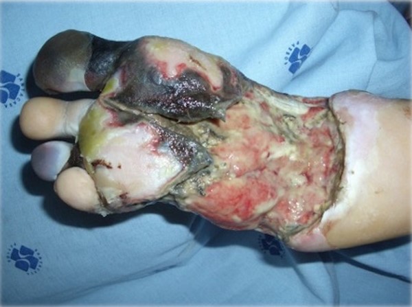 Wet gangrene. By Ferreira, LM.