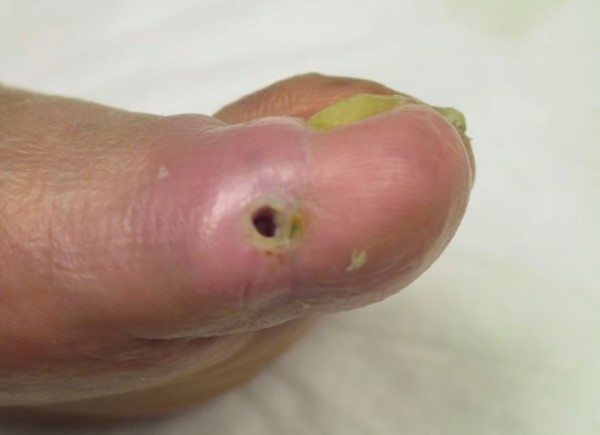 Pure arterial ulcer. By Worth E.