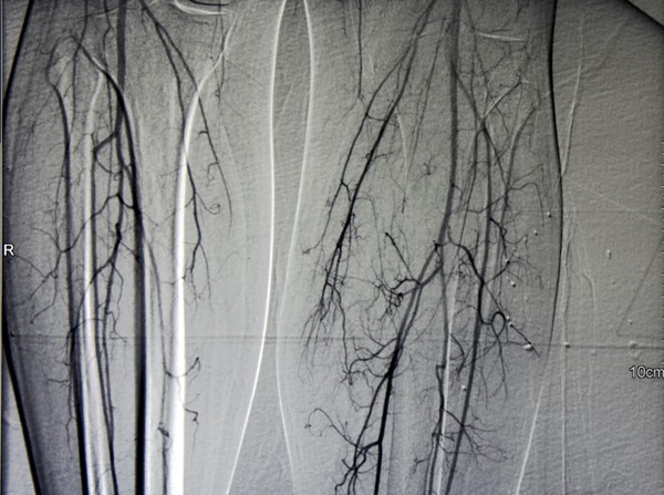Catheter digital subtraction angiography (DSA) - left and right calves