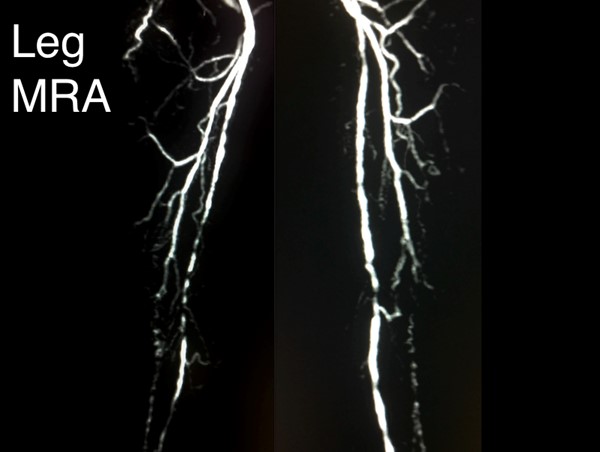 Magnetic resonance angiography of the legs