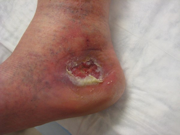 Venous leg ulcer. By Lebedinskaya N.