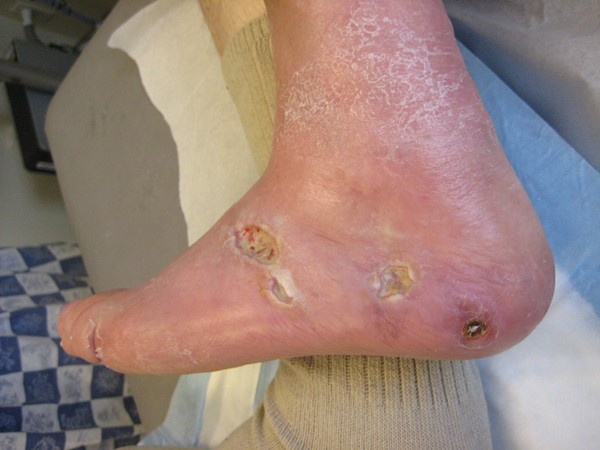 Arterial ulcer. By Lebedinskaya N.