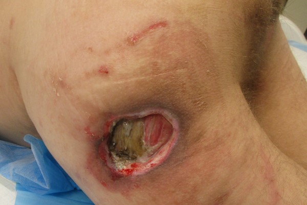 1a. Trochanteric pressure ulcer stage IV