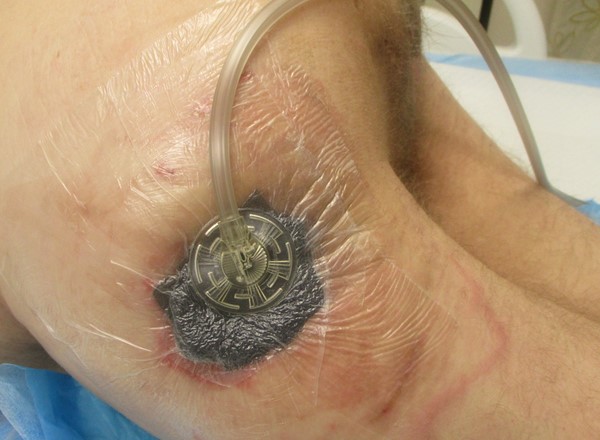 1h.  Suction on and dressing deflated to the skin level