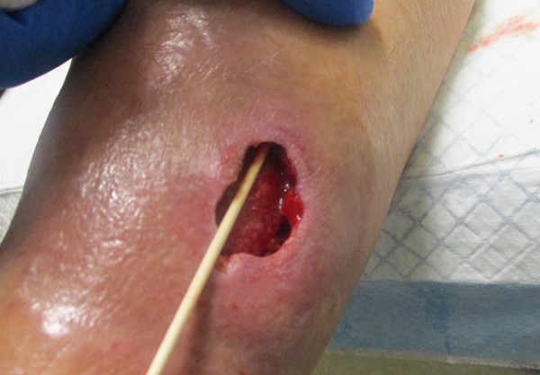 2b. Assessing undermining