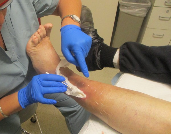 2d. Gauze* packing into undermining