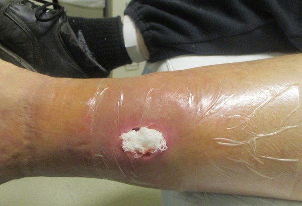2e. Wound packed with AMD gauze* moistened with saline