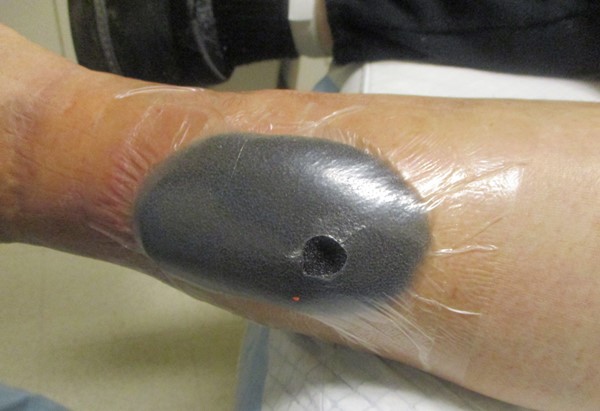 2g. Opening for suction tubing