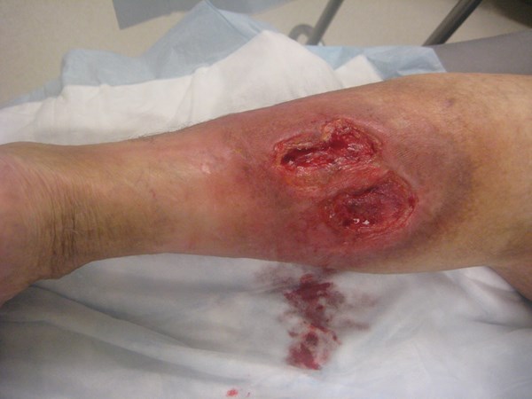 VLU post debrid1.JPG