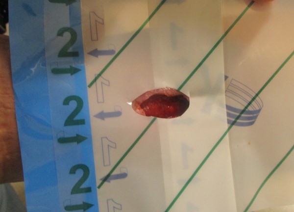 2c. Periwound draping