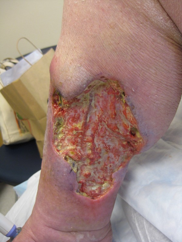 1.  Ulcer in right medial lower leg
