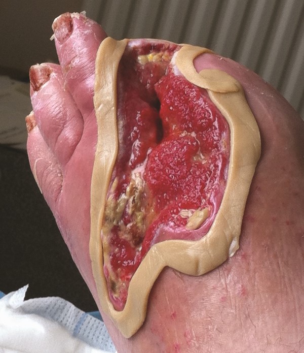 Stoma paste around edge (Labeled for reuse. Nursingtimes.net)