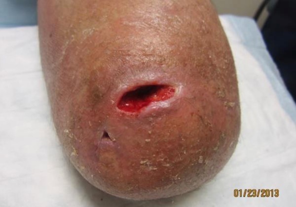 10. Ulcer in stump