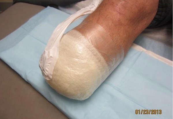 11. Circumferential NPWT in stump