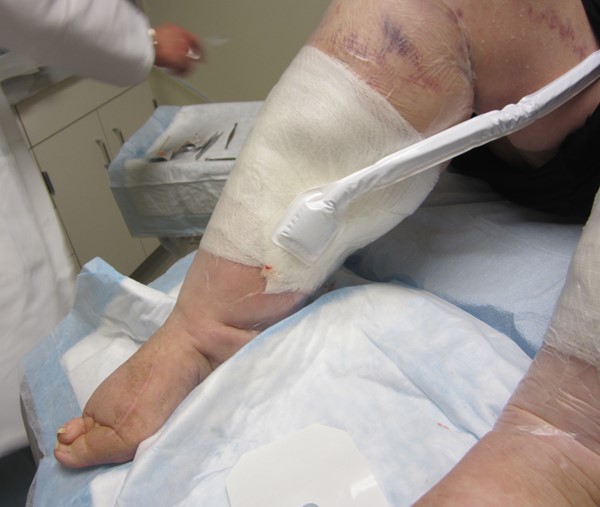 7. NPWT tubing applied