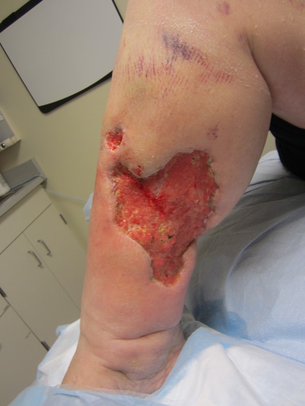 8. Wound contraction and granulation, week 3 