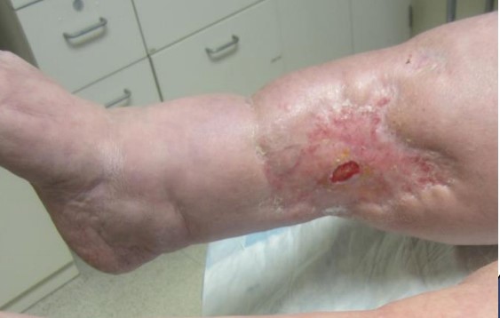 9. Ulcer almost completely healed, week 8