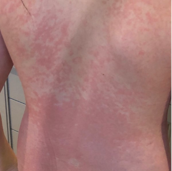Morbilliform rash on back CC BY 4.0 McMahon D et al