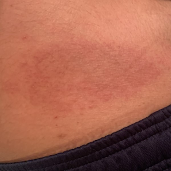 Erythematous rash on abdomen. CC BY 4.0 McMahon D et al
