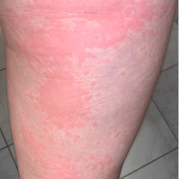 Urticarial rash on posterior thigh. CC BY 4.0 McMahon D et al