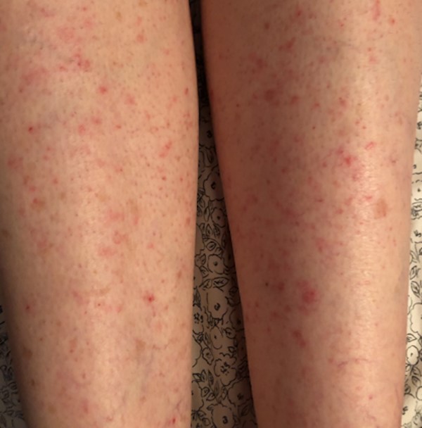 Papulovesicular exanthem on legs CC BY 4.0