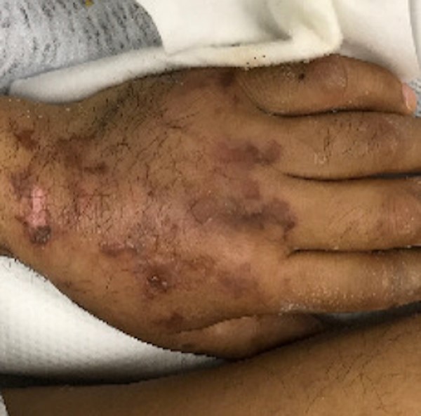 Retiform purpura CC BY 4.0 McMahon D et al