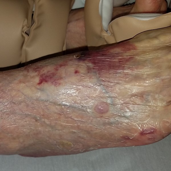 Retiform purpura on dorsum of foot. By Milne, C