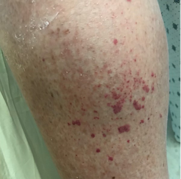 Petechiae/purpura on calf CC BY 4.0 McMahon D et al