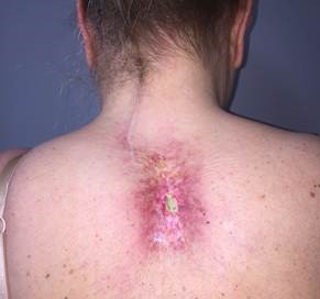 Chronic radiation-induced ulceration and fibrotic tissue