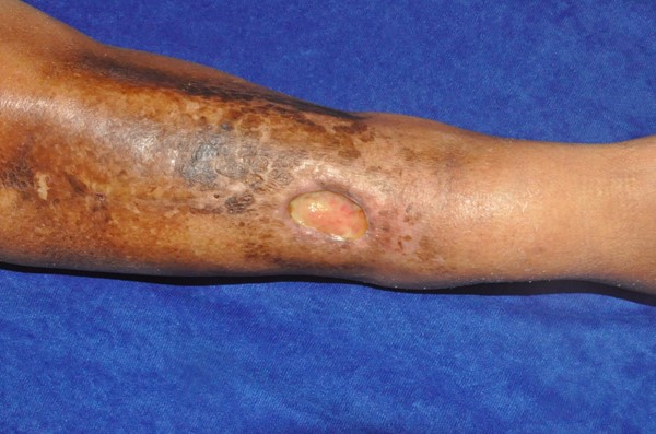 Chronic radiation-induced ulceration and hyperpigmentation of the leg