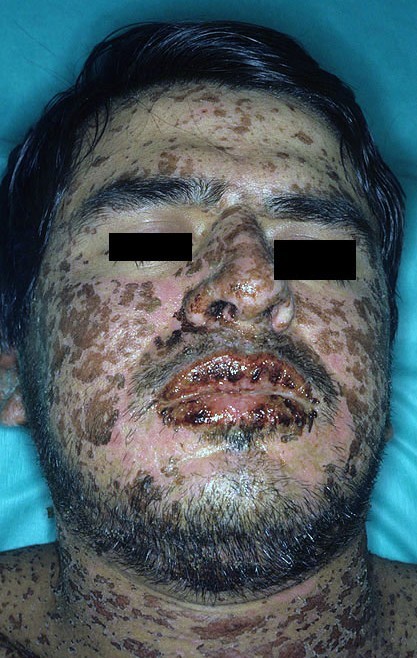  Steven-Johnson Syndrome